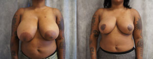 Breast-Reduction-Patient-Results-BA-Pasadena-Surgeons