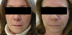 before&after-injectables