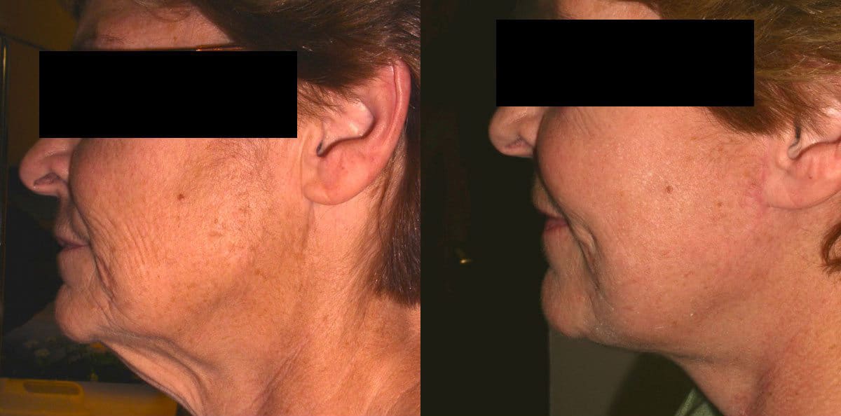 Excitement About Botox Pasadena, Ca - Los Angeles - Dr. Panossian thumbnail