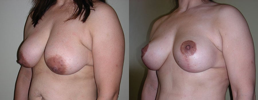 ba los angeles breast reduction surgery 1