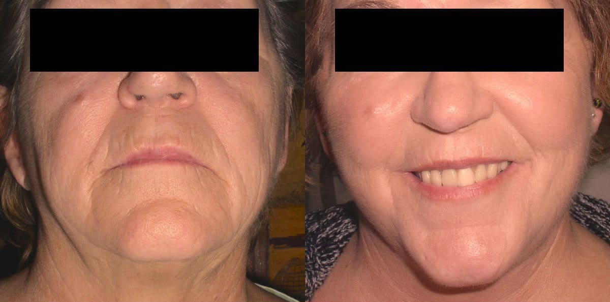 ba los angeles facelift surgery