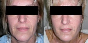 beforeafter face injectables pasadena