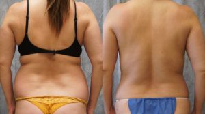 liposuction pasadena results ba5