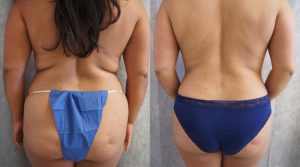 liposuction surgery ba4 1