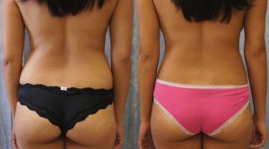 liposuction surgery los angeles ba3