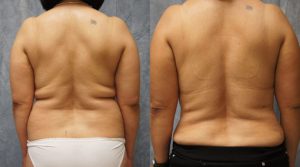 liposuction surgery pasadena ba1