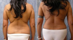 liposuction surgery pasadena ba2