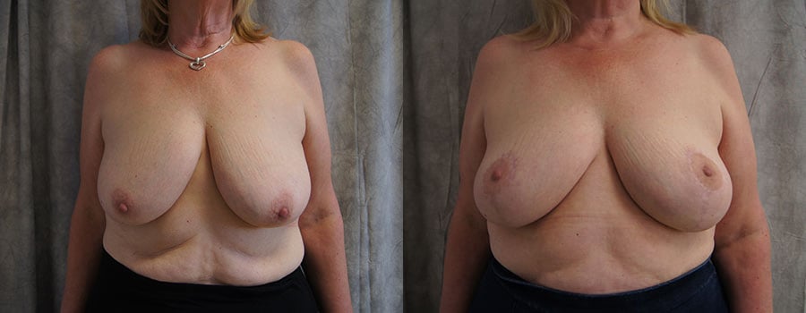 pasadena breast reduction surgery results ba