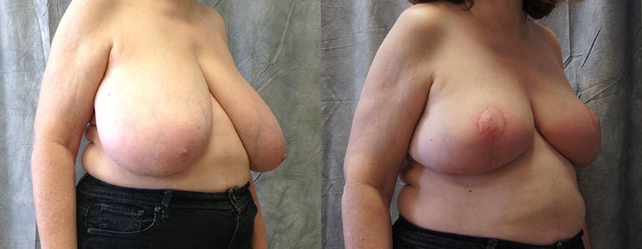 pasadena breast reduction surgery results ba1