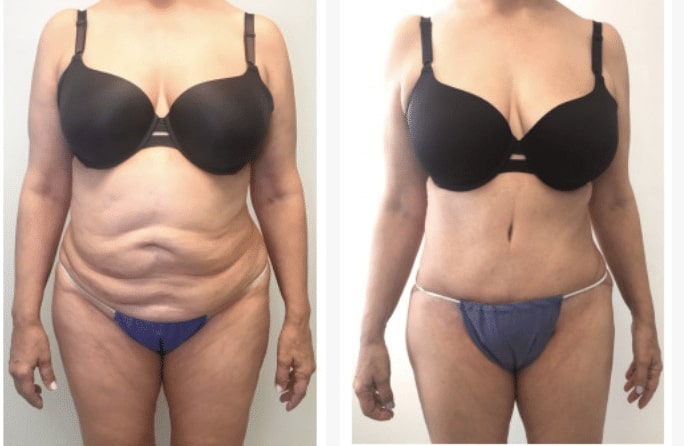 Abdominoplasty Results - IM CLINIC