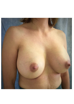 Breast Augmentation Patient 2