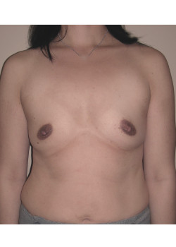 Breast Augmentation Patient 6