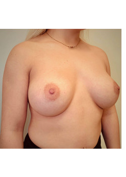 Breast Augmentation Patient 13