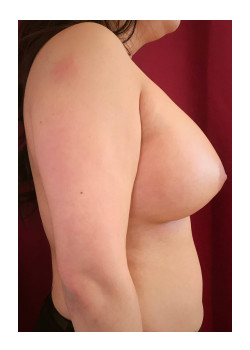 Breast Augmentation Patient 16