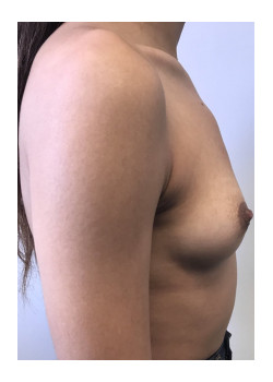 Breast Augmentation 20