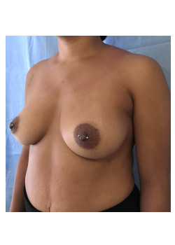 Breast Augmentation Patient 21