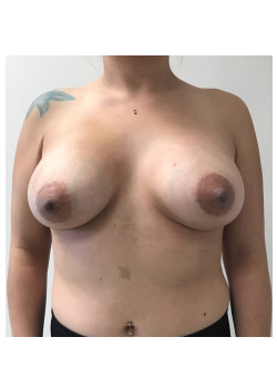 Breast Augmentation Patient 22