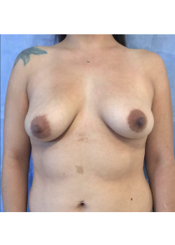 Breast Augmentation Patient 22