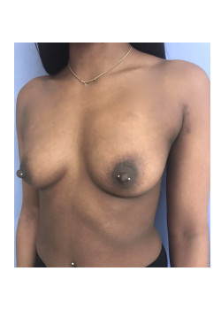 Breast Augmentation Patient 25