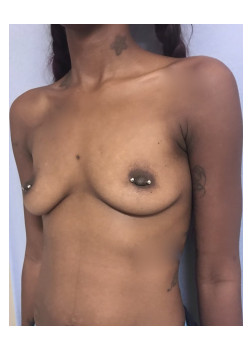 Breast Augmentation Patient 28