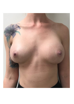 Breast Augmentation Patient 30