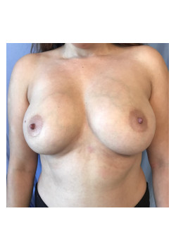 Breast Augmentation Patient 31