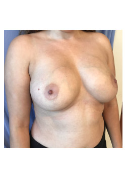 Breast Augmentation Patient 31