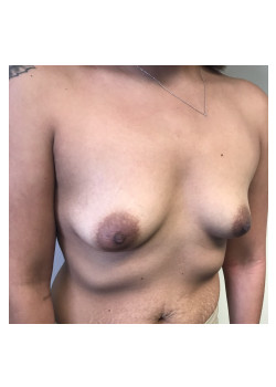 Breast Augmentation Patient 32