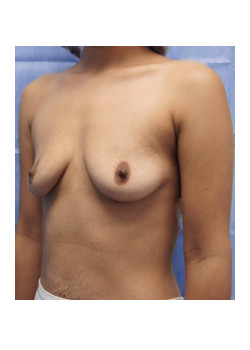 Breast Augmentation Patient 42