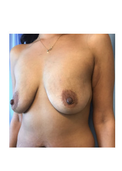 Breast Augmentation Patient 43