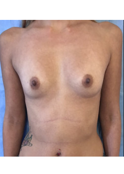 Breast Augmentation Patient 46