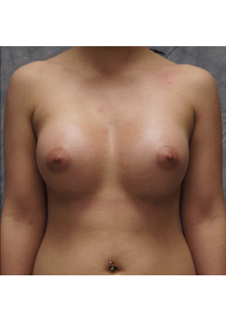 Breast Augmentation Patient 48
