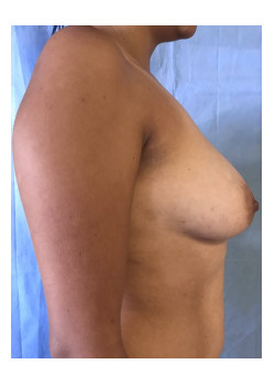 Breast Augmentation Patient 51