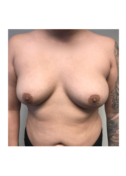 Breast Augmentation Patient 53