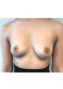 Breast Augmentation Patient 54