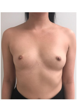 Breast Augmentation Patient 56
