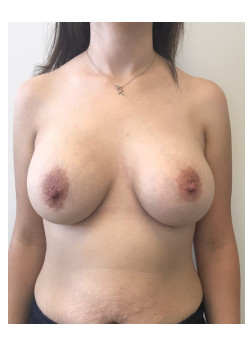 Breast Augmentation Patient 58