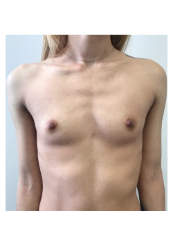 Breast Augmentation Patient 59