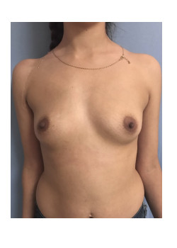 Breast Augmentation Patient 61