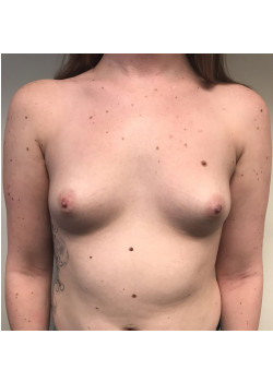 Breast Augmentation Patient 63