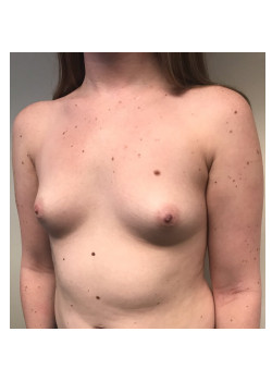Breast Augmentation Patient 63