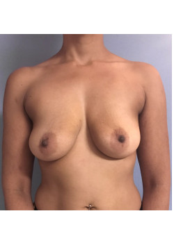 Breast Augmentation Patient 65