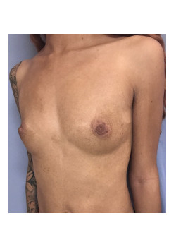 Breast Augmentation Patient 66