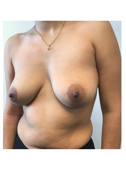 Breast Augmentation Patient 67