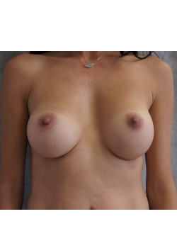 Breast Augmentation Patient 68