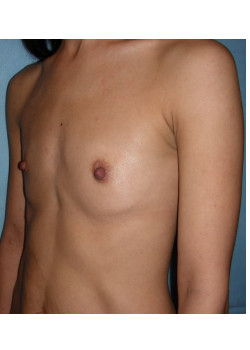 Breast Augmentation Patient 70