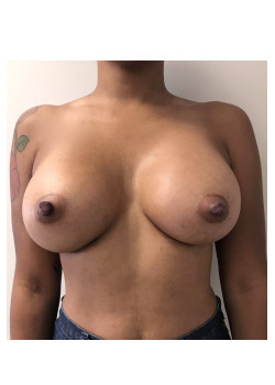 Breast Augmentation Patient 71