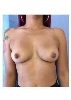 Breast Augmentation Patient 71