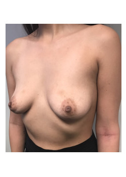 Breast Augmentation Patient 72