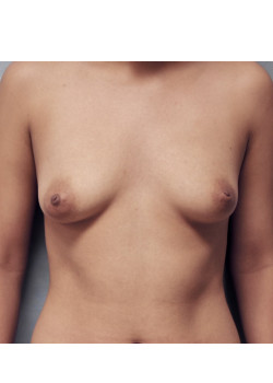 Breast Augmentation Patient 73